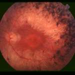 https://dioptrija.hr/bolesti-oka/retinitis-pigmentosa-rp-sto-se-lijeci