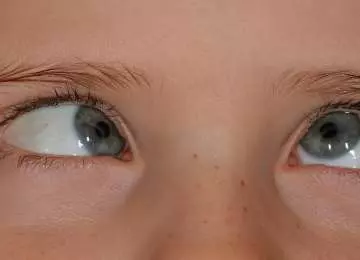 Što je strabizam i kako se liječi?