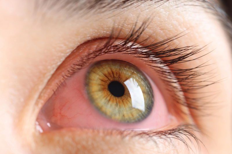 Crvene oci ujutro uzroci