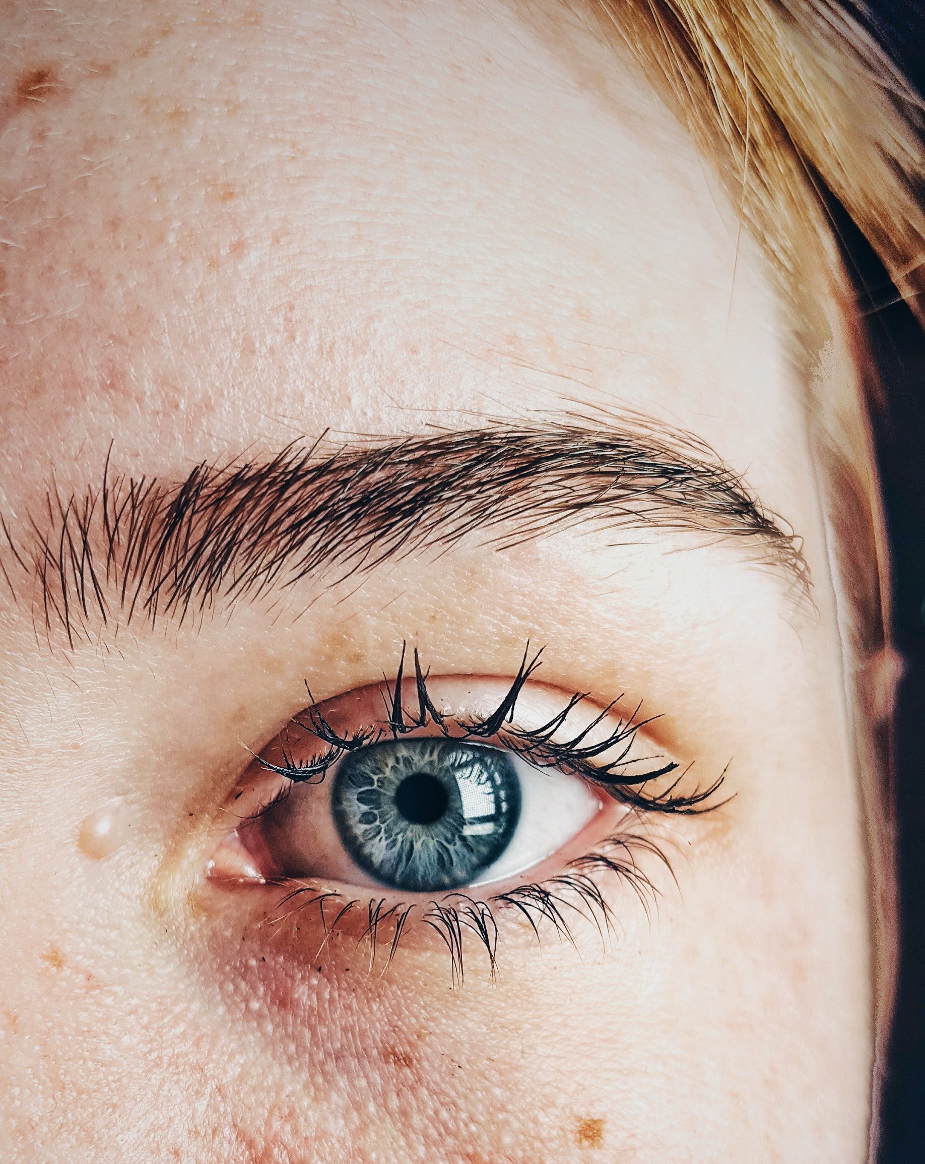 disfunkcija Meibomove žlijezde suhe oči